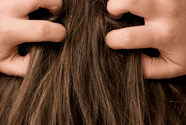 White Dots in Hair: Lice, Dandruff, or Something Else? cover
