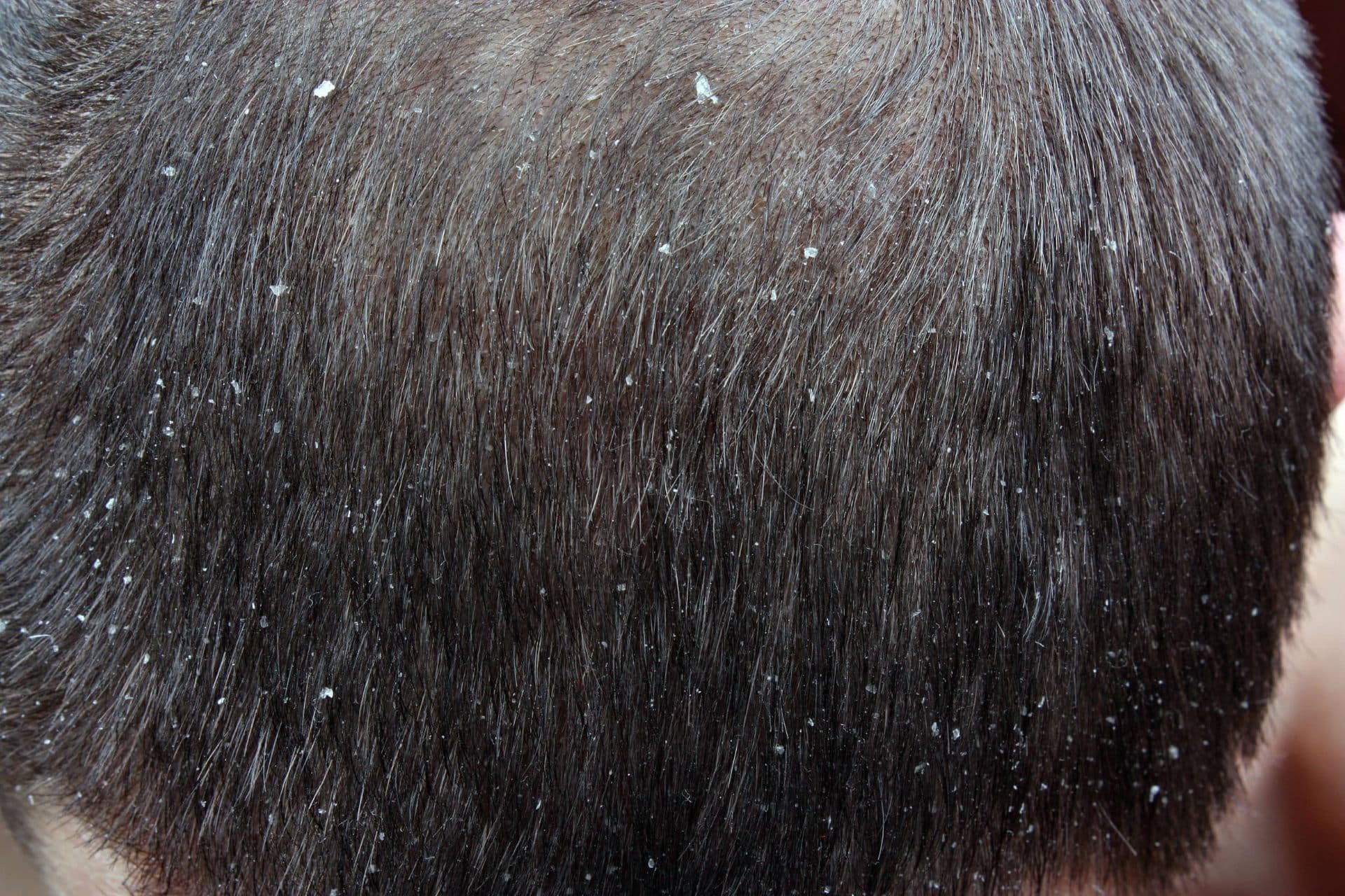 Dandruff flakes across the scalp for comparison