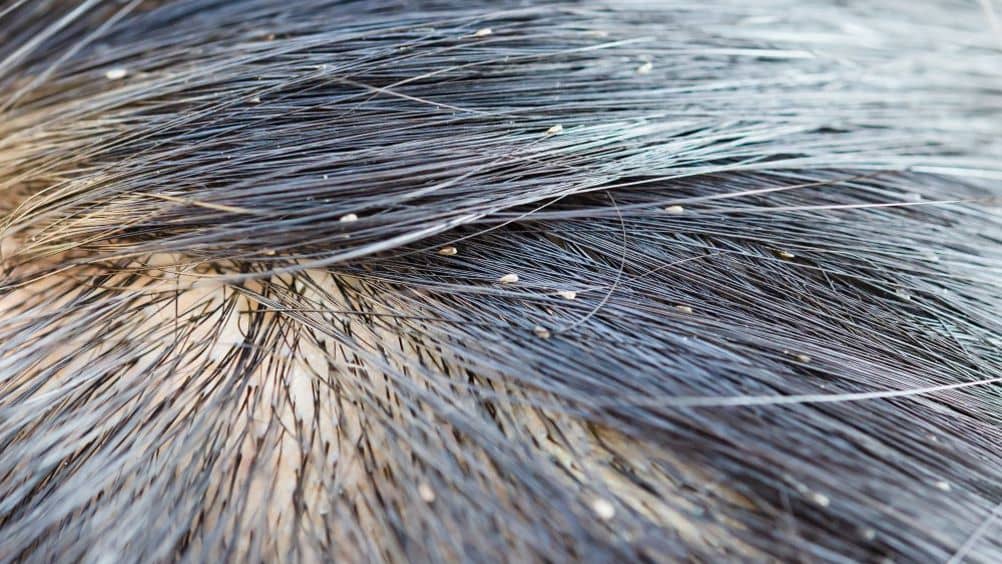 Nits attached to individual hair shafts near the scalp