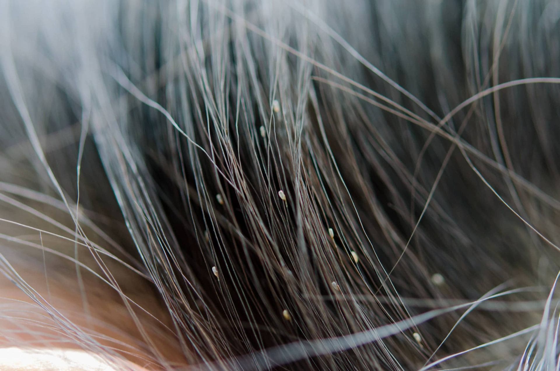 Close-up of head lice and eggs in dark hair